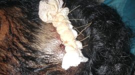 Salah satu Korban pengeroyokan dari kampung Bempo Kec. Lembor pada malam pergantian tahun 2025