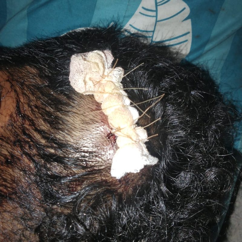 Salah satu Korban pengeroyokan dari kampung Bempo Kec. Lembor pada malam pergantian tahun 2025