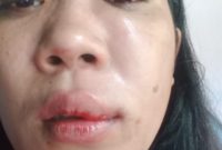 Wati, salah satu Korban penganiayaan sekelompok orang di Raba, kelurahan Wae Kelambu, Labuan Bajo