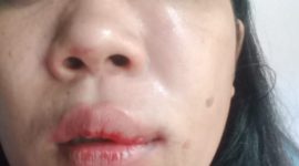 Wati, salah satu Korban penganiayaan sekelompok orang di Raba, kelurahan Wae Kelambu, Labuan Bajo