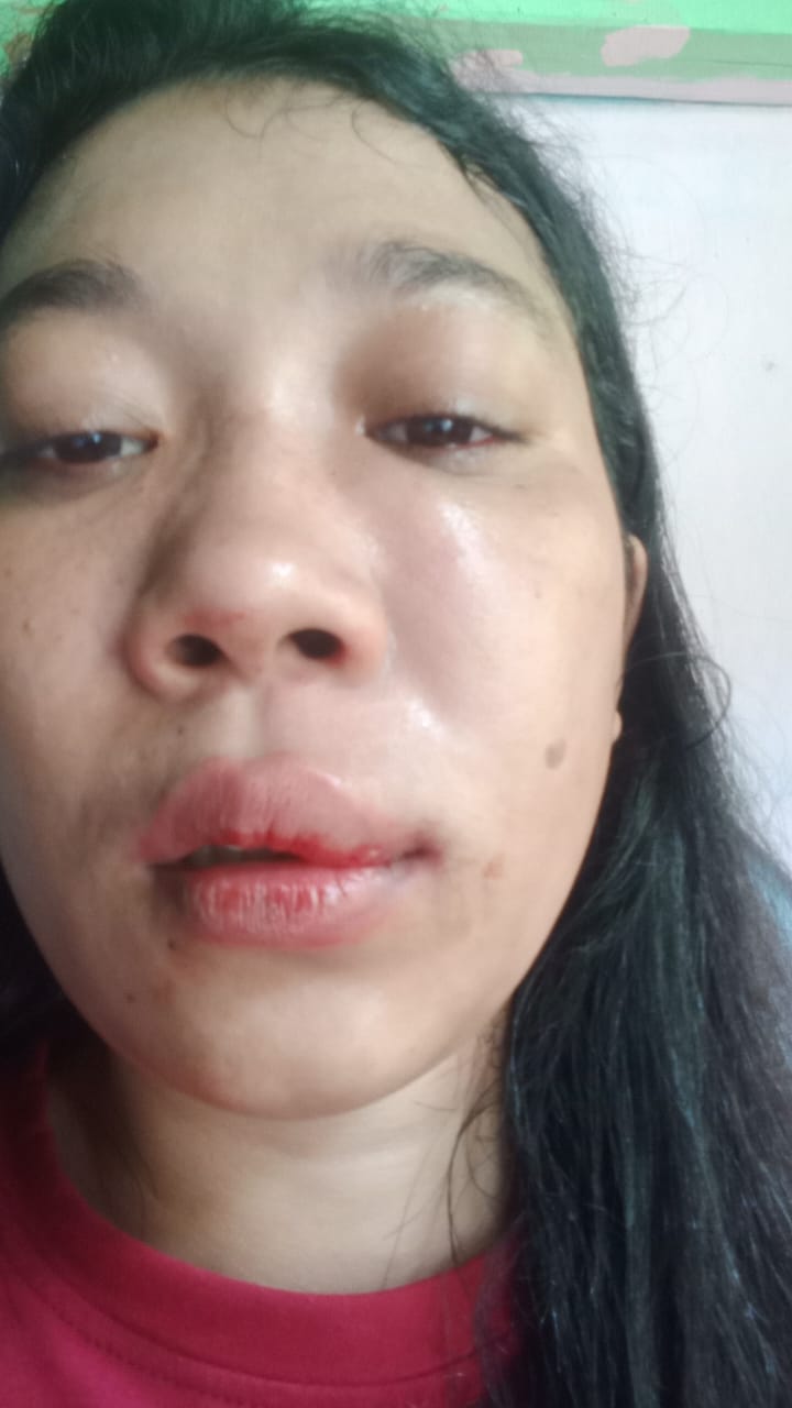 Wati, salah satu Korban penganiayaan sekelompok orang di Raba, kelurahan Wae Kelambu, Labuan Bajo